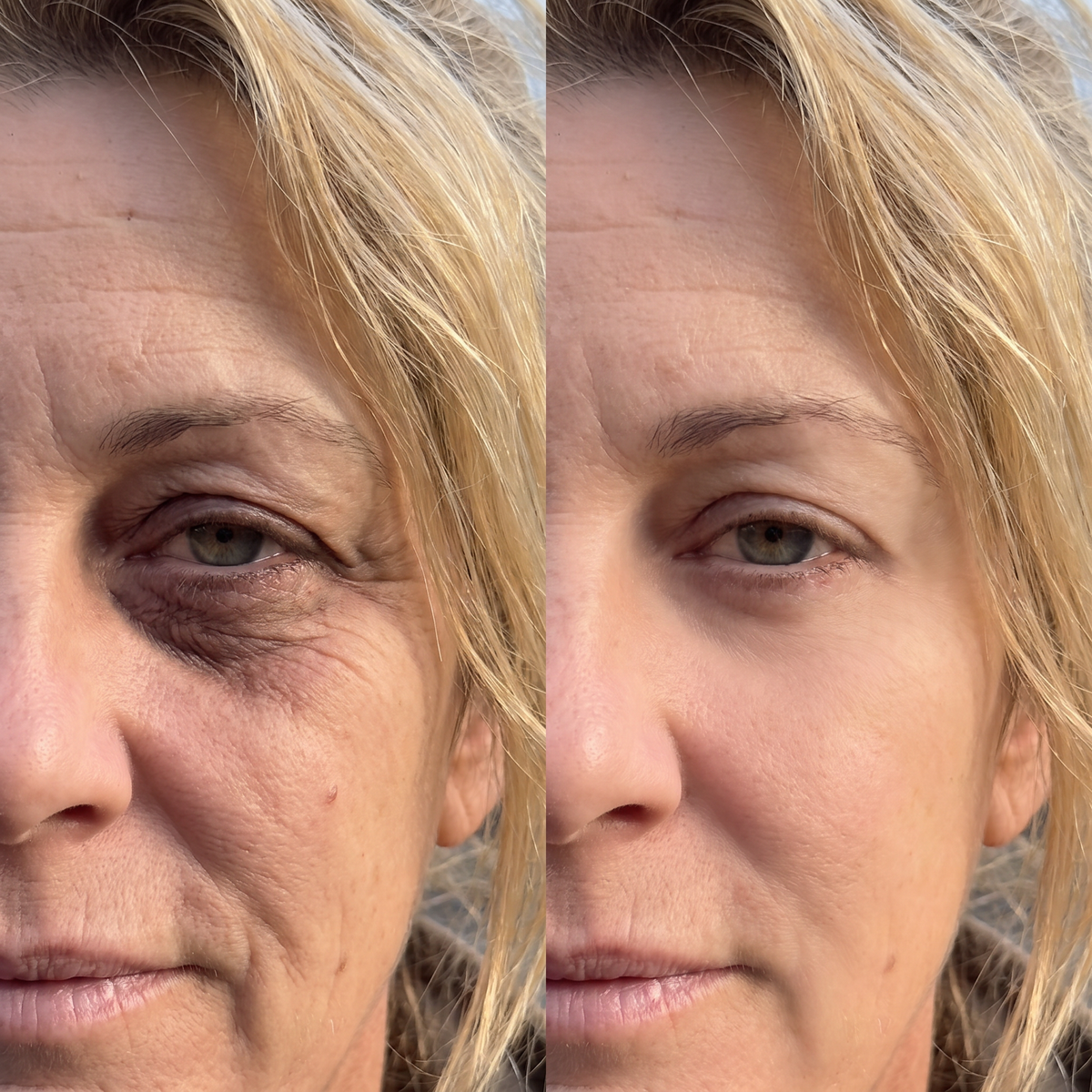 Lumera Pro - Red Light Therapy + EMS To Erase Eye Bags