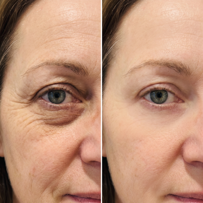 Lumera Pro - Red Light Therapy + EMS To Erase Eye Bags